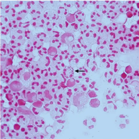 Cerebrospinal Fluid (CSF) for Gram Stain